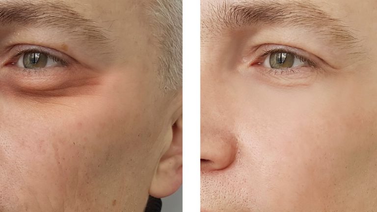 blefaroplastia-palpebra-inferior-2.jpg